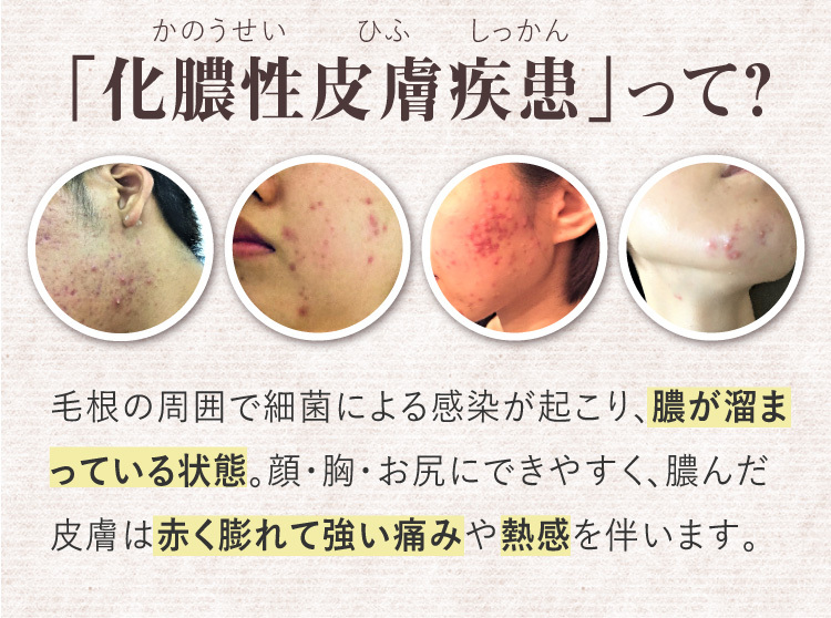 創業昭和23年製薬会社から発売、何をしてもダメだったブツブツ肌に、鏡を見るたび落ち込む肌荒れから解放！、何度もくり返す大人ニキビなどの化膿性皮膚疾患、毎食間のこれ1包で、効果効能、化膿性皮膚疾患、歯肉炎、扁桃炎、何度もくり返す、保存料なし、ステロイドフリー、国内製造、ニキビ、にきび